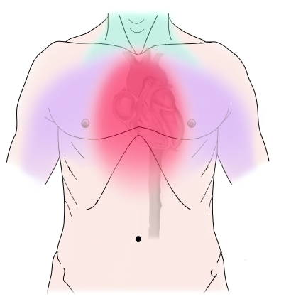 schéma angine